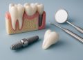 Dental implant procedure illustration highlighting key steps for prospective patients