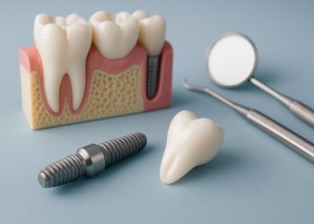 Dental implant procedure illustration highlighting key steps for prospective patients