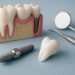 Dental implant procedure illustration highlighting key steps for prospective patients